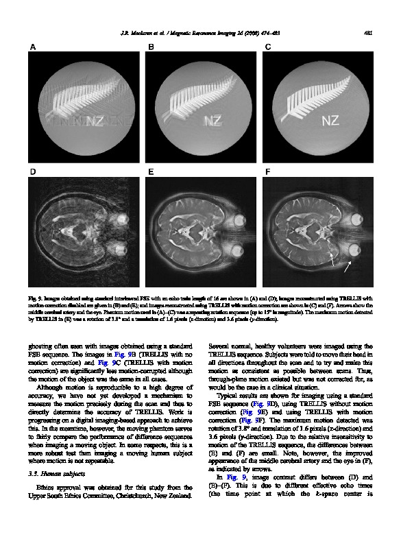 Download MRI with TRELLIS: a novel approach to motion correction.